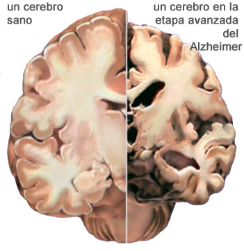 Patologías cerebrales